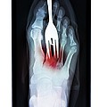 foot-fork-stabbing-injury-x-ray-du-cane-medical-imaging-ltd.jpg