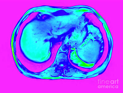Royalty-Free and Rights-Managed Images - Abdomen MRI scan q1 by Ilan Rosen