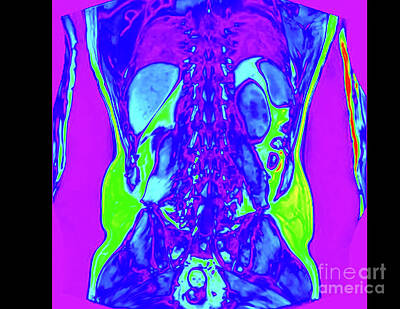 Royalty-Free and Rights-Managed Images - Abdomen MRI scan w9 by Ilan Rosen